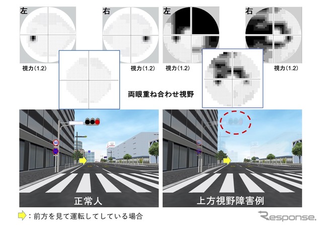 上は視野検査の結果。黒い部分が見えていない。左上は正常な人の視野（黒い部分は盲点。全員にある）。右上は、視野障害があり見えない部分が広がっている人の視野。二人ともそれぞれ、視力は1.2あるものの（免許更新に問題がない）、視野障害がある人の左右両眼を重ね合わせた視野は、ちょど信号を見るあたりが欠けているため、実際には信号そのものが消えて見える。