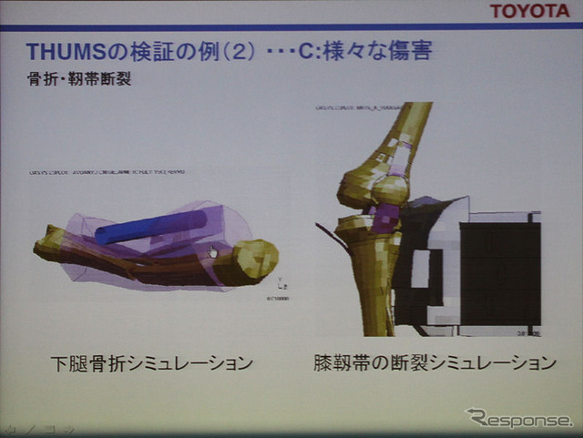 骨折やじん帯断裂のシミュレーション