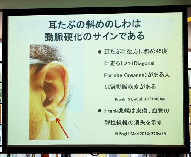 動脈硬化のサインについて(講演資料)
