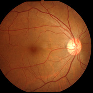 私の右目の眼底写真。はりめぐっているのは血管。白く光る小さな丸い部分が視神経のあるところ。この形や色に異常がないかを確認する。