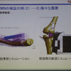 骨折やじん帯断裂のシミュレーション